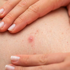 Avaderma Skin & Hair Clinic - Tinea Corporis (Ringworm)